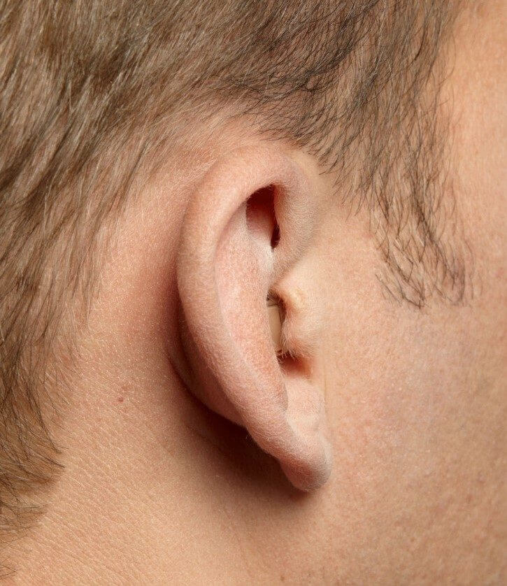 Im-Ohr-Hörgerätetypen CIC
